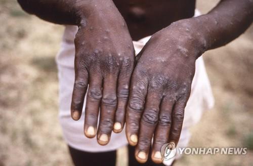 브라질서 외국여행 않은 원숭이두창 확진자 발생…외국인 접촉